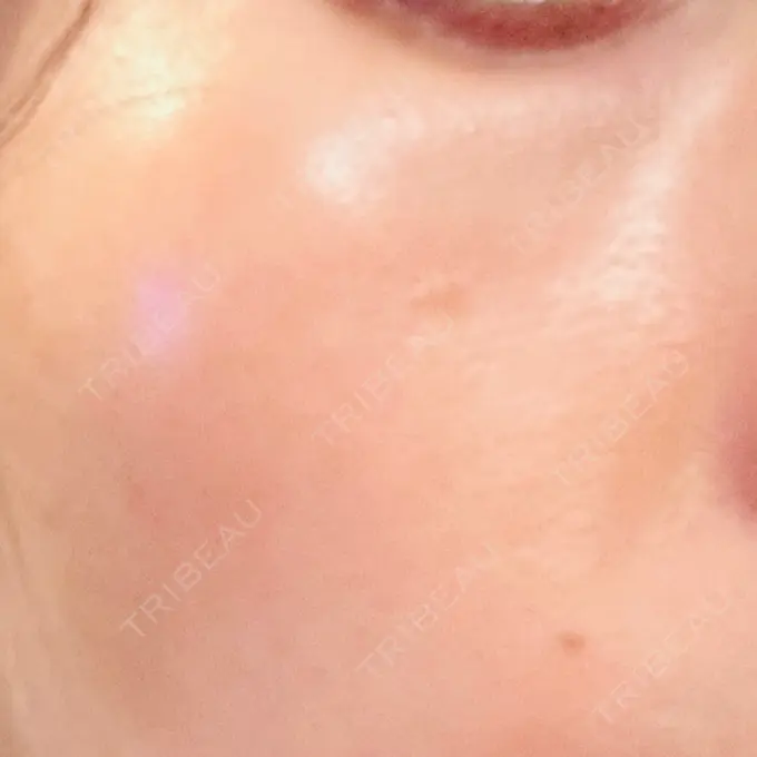 LDM・インテンスウルトラ 品川スキンクリニック広島院 DAY 4 メイン用