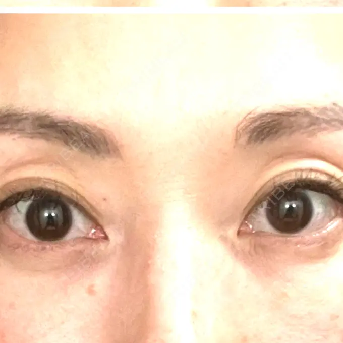 クマ治療 セオリークリニック AFTER メイン用