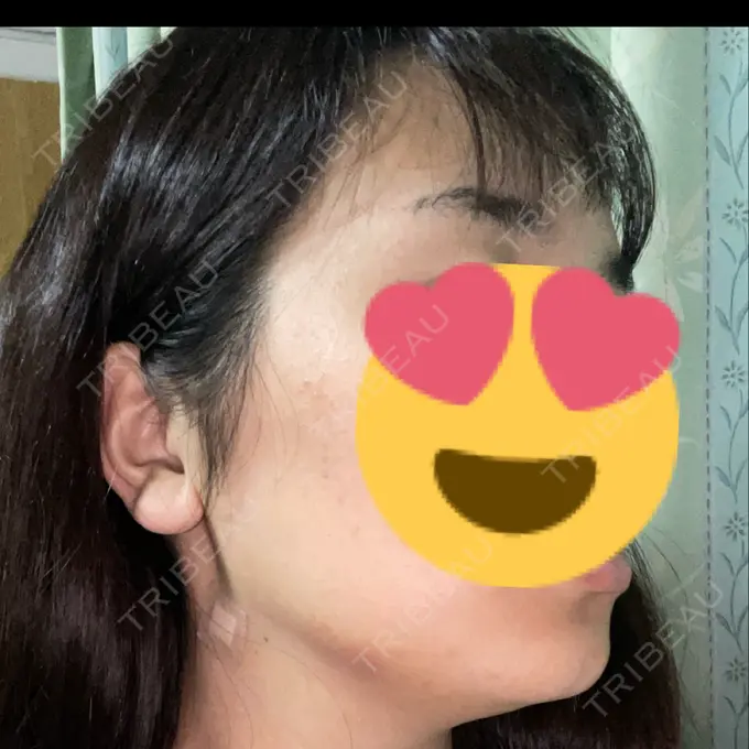 糸リフト / 脂肪吸引（顔） / ジョールファット除去 / ボトックス（エラ・小顔） RIVER CLINIC（リバークリニック） DAY 1 メイン用