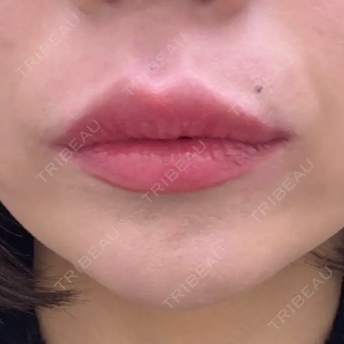 ヒアルロン酸注入（唇） 目白ホワイトクリニック DAY 0 メイン用