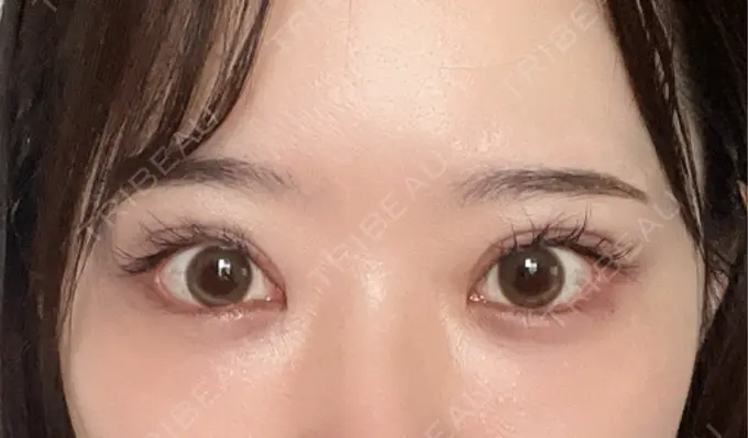 クマ治療 / 下まぶたの脂肪取り / 脂肪注入（目の下） ルラ美容クリニック 渋谷本院 DAY 18 メイン用