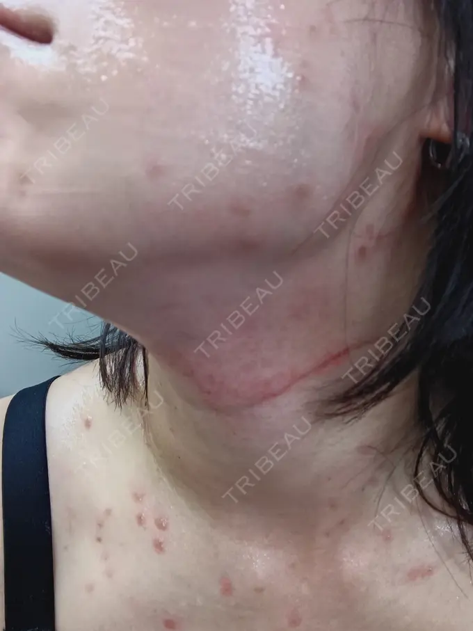 シミ取りレーザー / インモード 東京シルククリニック 新宿院 DAY 0 メイン用