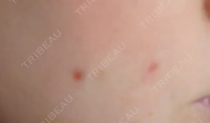 ほくろ・いぼ切除（肌） 札幌中央クリニック DAY 9 メイン用