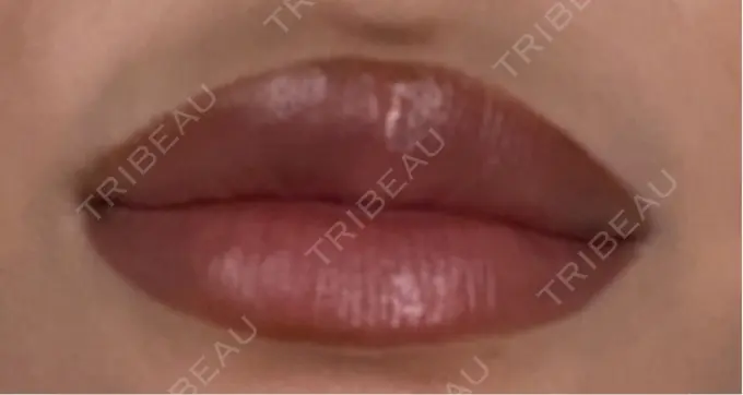 ヒアルロン酸注入（唇） 麻布十番クレールデンタルクリニック DAY 2 メイン用