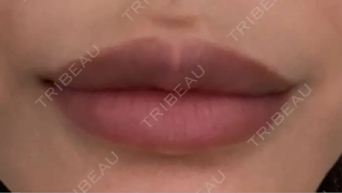 ヒアルロン酸注入（唇） 麻布十番クレールデンタルクリニック DAY 3 メイン用
