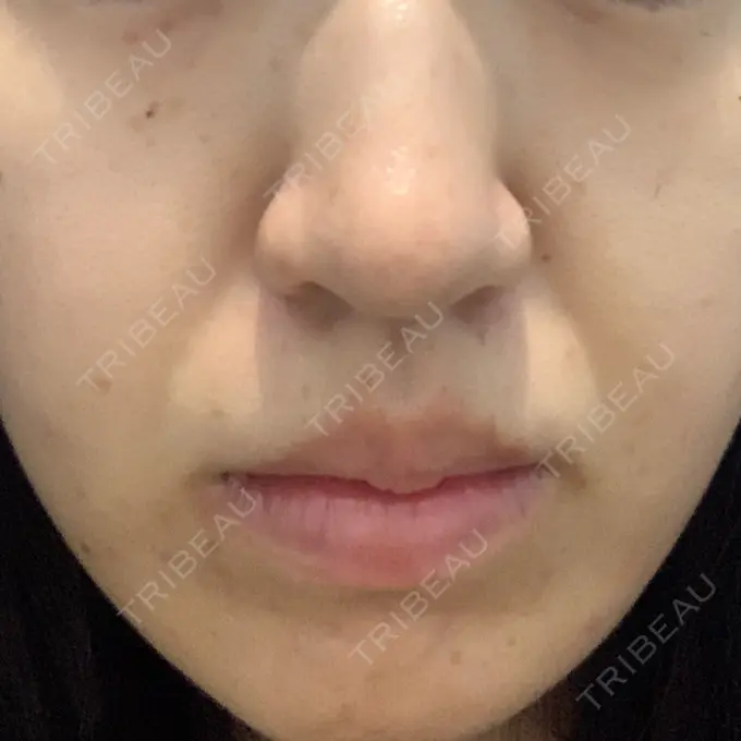 ピーリング（ニキビ・毛穴） / ルメッカ ルラ美容クリニック 千葉院 / ルラスキンクリニック 千葉院 AFTER メイン用