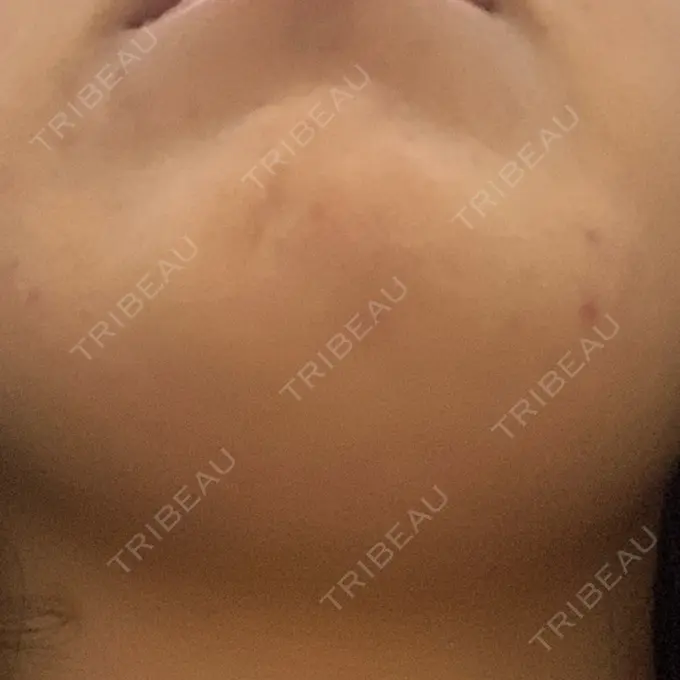 ピーリング（ニキビ・毛穴） / ルメッカ ルラ美容クリニック 千葉院 / ルラスキンクリニック 千葉院 DAY 0 メイン用