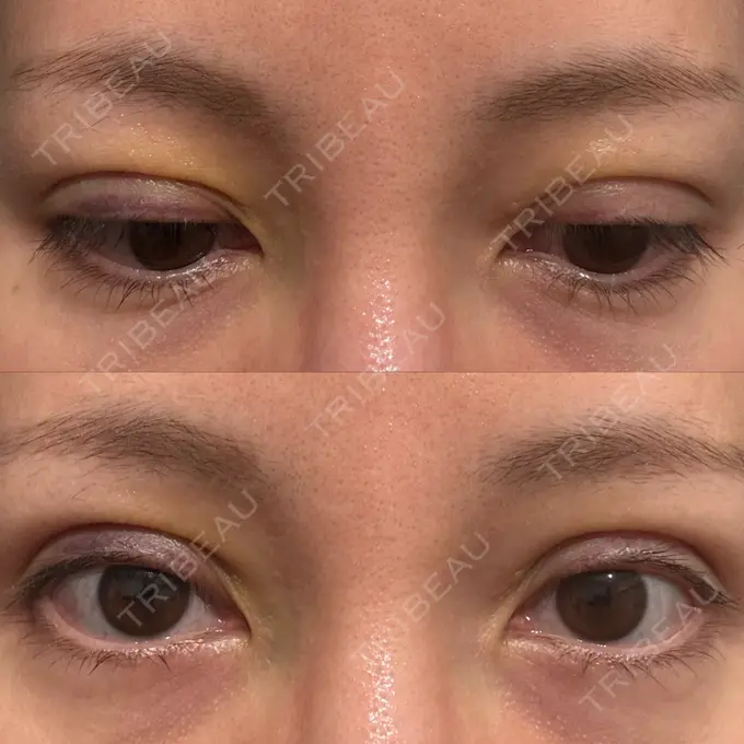 二重埋没 湘南美容クリニック 博多院 DAY 3 メイン用