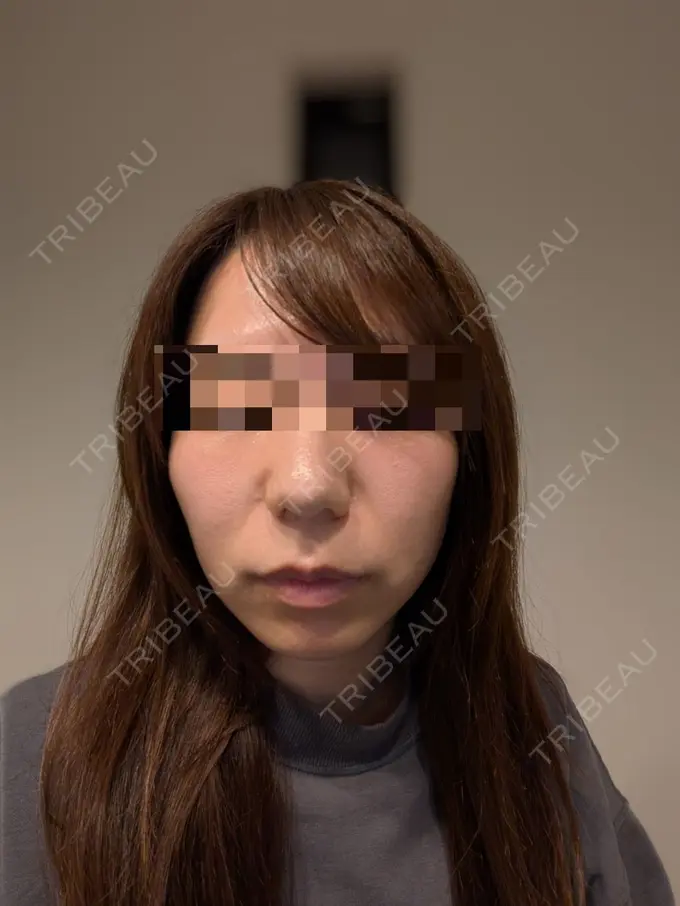 ピーリング（ニキビ・毛穴） Sea Sail Beauty Clinic AFTER メイン用