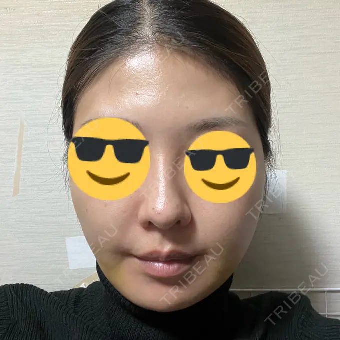 糸リフト / バッカルファット除去 / 脂肪吸引（顔） / ヒアルロン酸注入（頬） eクリニック 福岡院 DAY 7 メイン用