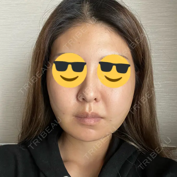 糸リフト / バッカルファット除去 / 脂肪吸引（顔） / ヒアルロン酸注入（頬） eクリニック 福岡院 DAY 7 メイン用