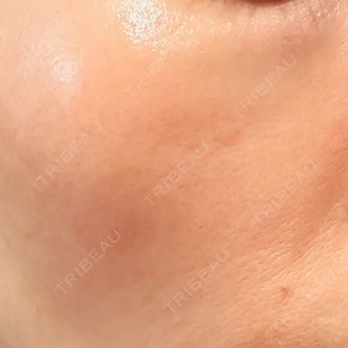 LDM・インテンスウルトラ 品川スキンクリニック広島院 DAY 5 メイン用