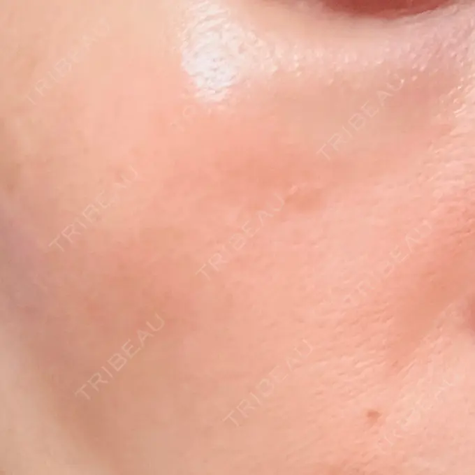 LDM・インテンスウルトラ 品川スキンクリニック広島院 DAY 6 メイン用