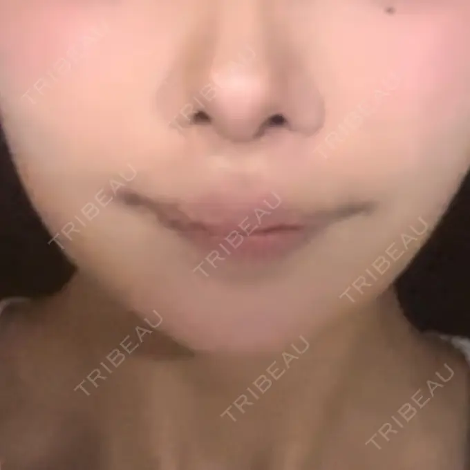 糸リフト / 脂肪吸引（顔） / ジョールファット除去 / 脂肪吸引注射（顔） SEA CLINIC（シークリニック） DAY 7 メイン用