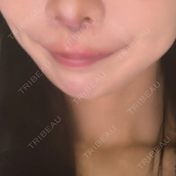 糸リフト / 脂肪吸引（顔） / ジョールファット除去 / 脂肪吸引注射（顔） SEA CLINIC（シークリニック） DAY 32 メイン用