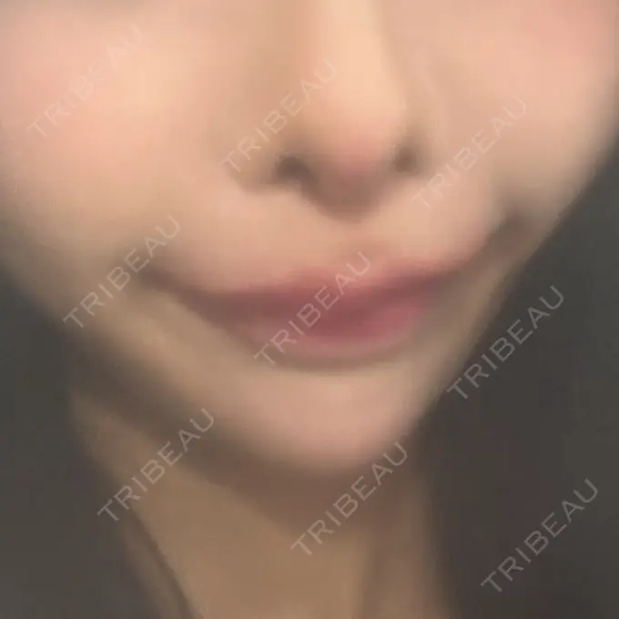 糸リフト / 脂肪吸引（顔） / ジョールファット除去 / 脂肪吸引注射（顔） SEA CLINIC（シークリニック） AFTER メイン用