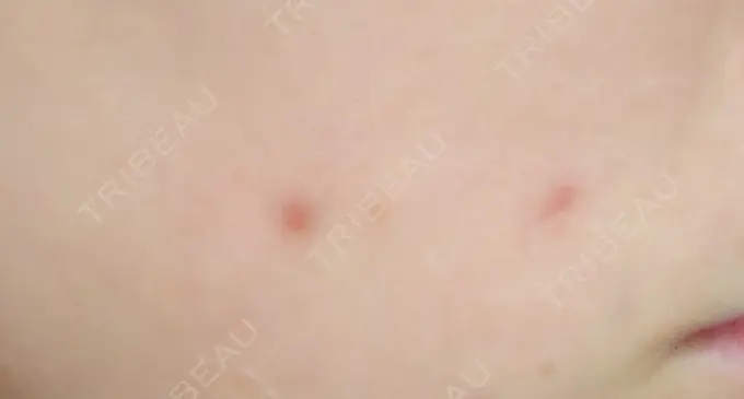 ほくろ・いぼ切除（肌） 札幌中央クリニック DAY 12 メイン用