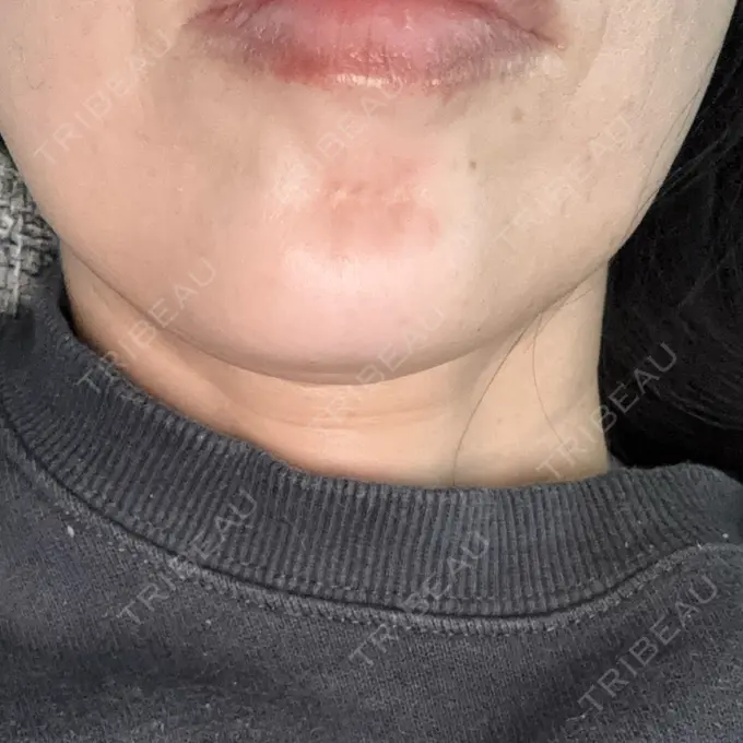 ボトックス（あご） DMTC美容皮膚科 大宮院 AFTER メイン用