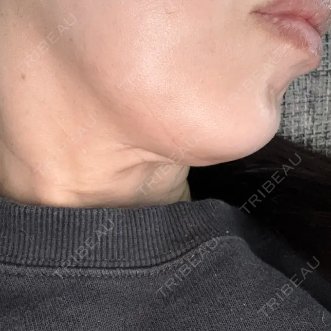 ボトックス（あご） DMTC美容皮膚科 大宮院 DAY 7 メイン用