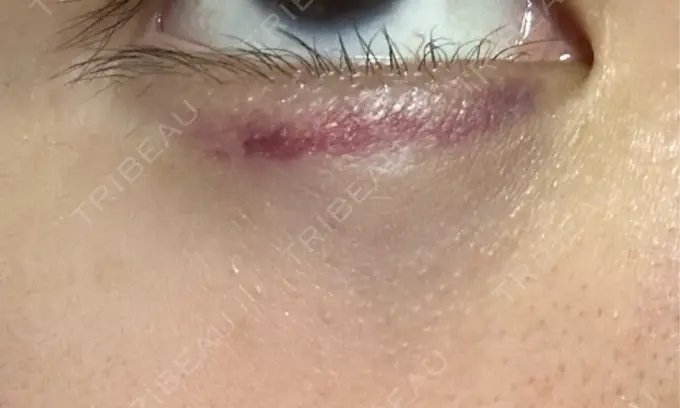 ボトックス（人中） / その他（目元） 東京形成美容外科 船橋院 DAY 1 メイン用