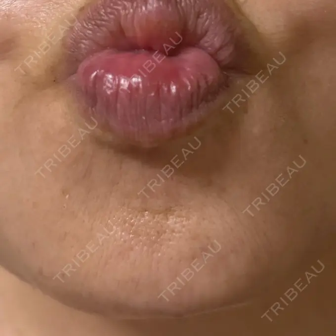 ボトックス（眉間） / ボトックス（目尻） / ボトックス（額） ルヴィクリニック イオンドーム前院 DAY 0 メイン用