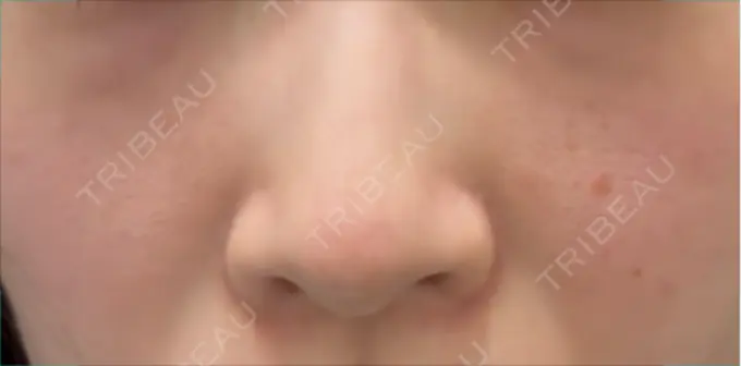 小鼻縮小（切開） 銀座S美容・形成外科クリニック AFTER メイン用