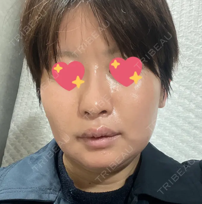 ハイフ（顔） しんゆり美容健康クリニック DAY 0 メイン用