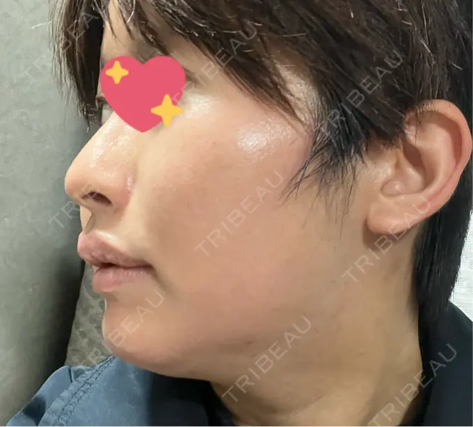 ハイフ（顔） しんゆり美容健康クリニック DAY 0 メイン用