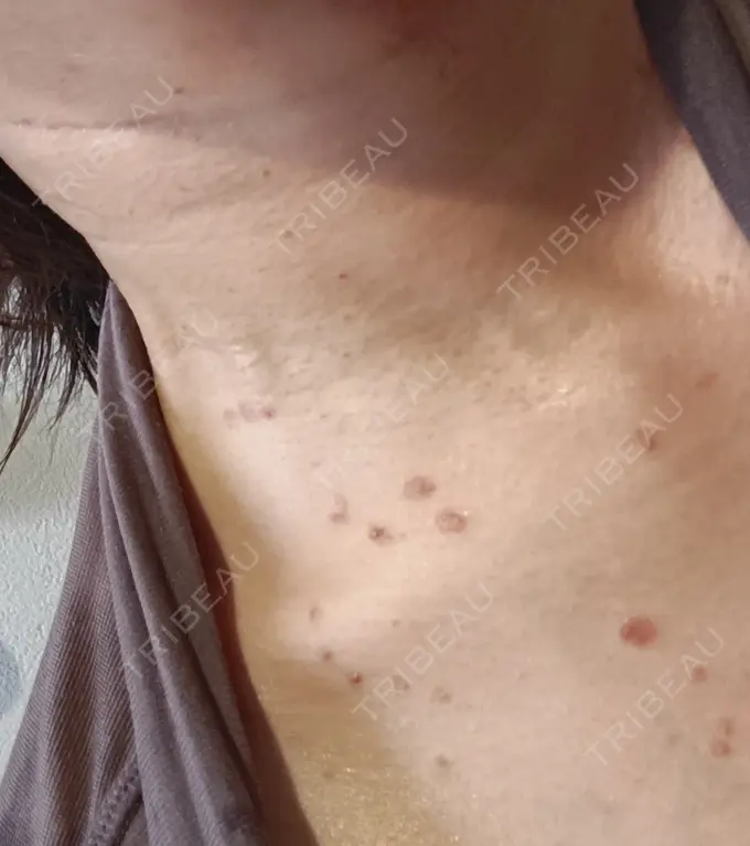 シミ取りレーザー / インモード 東京シルククリニック 新宿院 DAY 1 メイン用