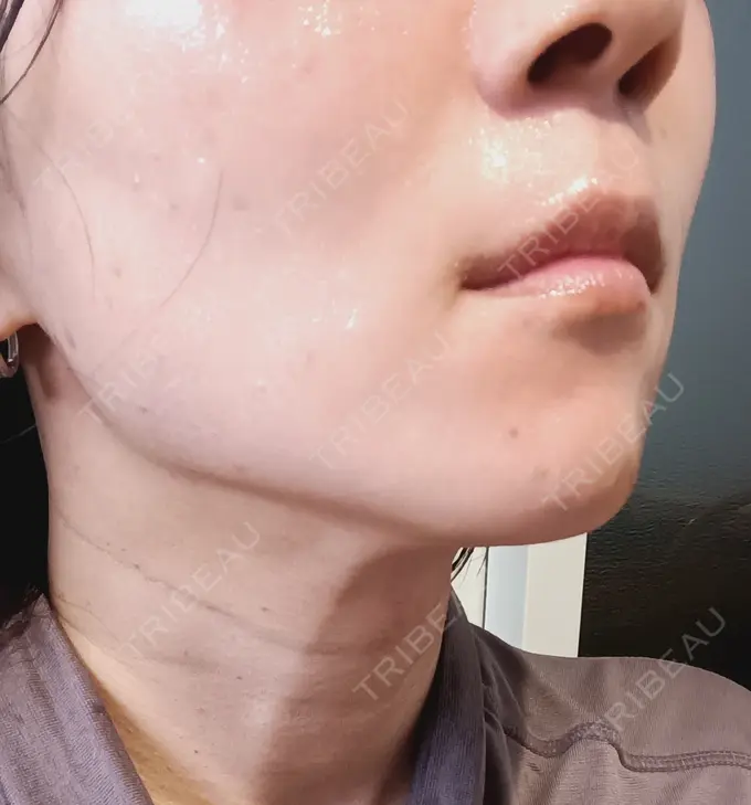 シミ取りレーザー / インモード 東京シルククリニック 新宿院 DAY 1 メイン用