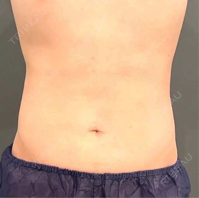 脂肪吸引（お腹） / 脂肪吸引（腰） オアシス美容外科 AFTER メイン用
