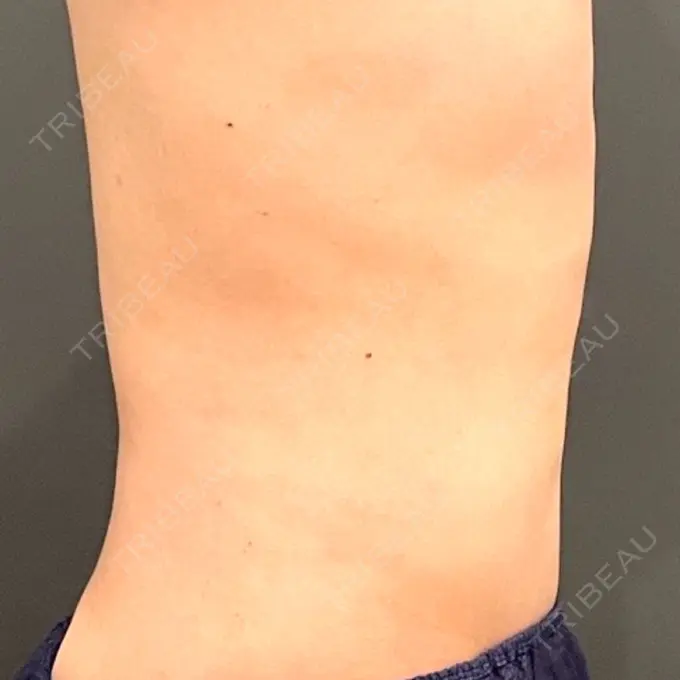 脂肪吸引（お腹） / 脂肪吸引（腰） オアシス美容外科 DAY 97 メイン用