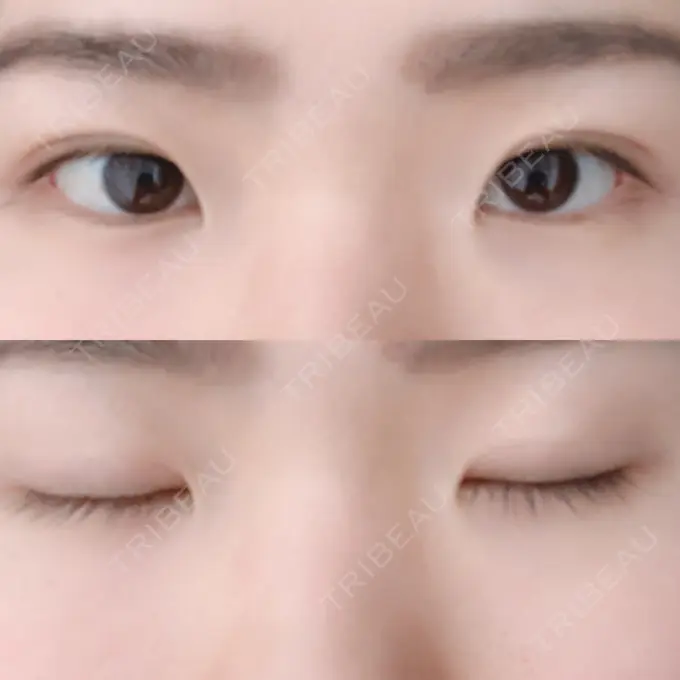 二重埋没 / 上まぶたの脂肪取り 東京ヒルズクリニック 岡崎院 DAY 42 メイン用