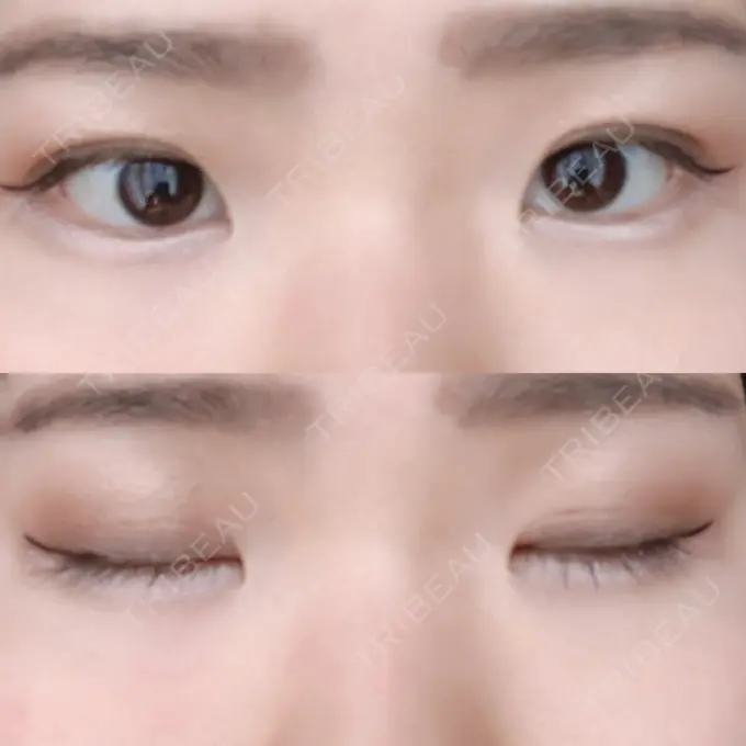 二重埋没 / 上まぶたの脂肪取り 東京ヒルズクリニック 岡崎院 DAY 42 メイン用