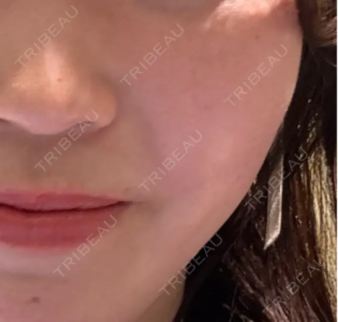 美肌レーザー / 美白レーザー / ピコレーザートーニング（美白・肝斑） / レーザートーニング（美白・肝斑） 銀座みゆき通り美容外科 大阪梅田院 DAY 0 メイン用