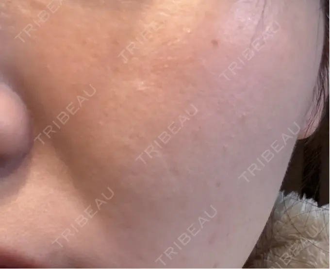 美肌レーザー / 美白レーザー / ピコレーザートーニング（美白・肝斑） / レーザートーニング（美白・肝斑） 銀座みゆき通り美容外科 大阪梅田院 AFTER メイン用