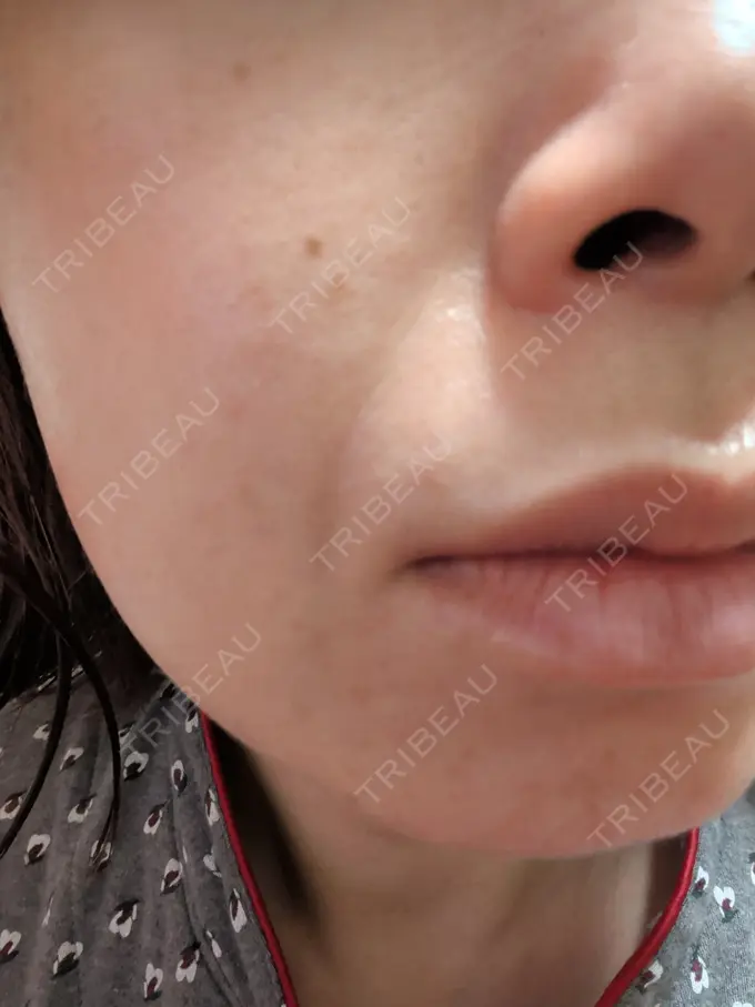 肌育注射（ジュベルックなど） ゆきスキンクリニック 東池袋 DAY 16 メイン用