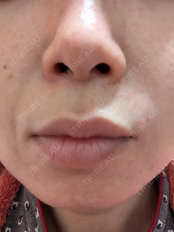 肌育注射（ジュベルックなど） ゆきスキンクリニック 東池袋 AFTER メイン用