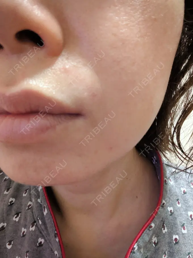 肌育注射（ジュベルックなど） ゆきスキンクリニック 東池袋 DAY 16 メイン用