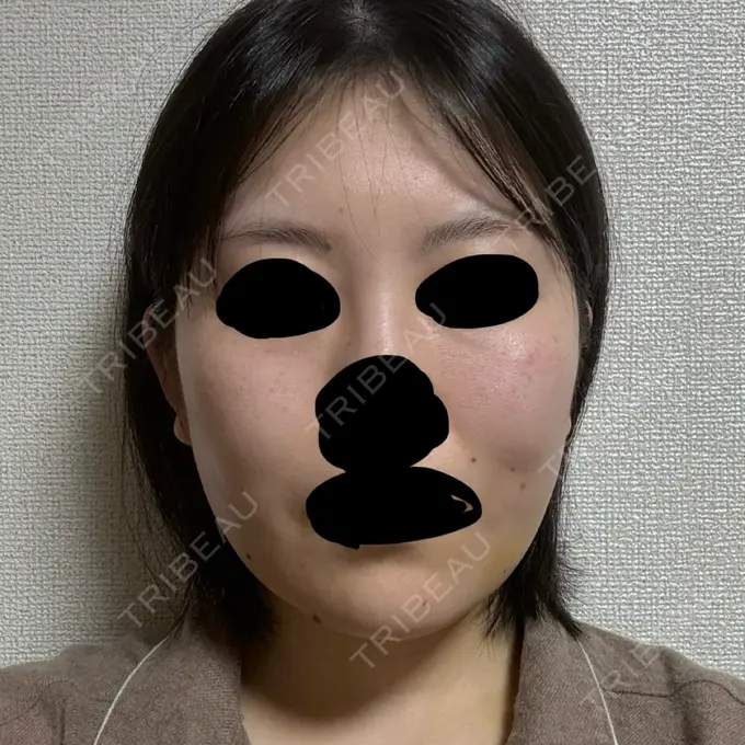 糸リフト / 脂肪吸引（顔） 東京ココセランクリニック DAY 12 メイン用