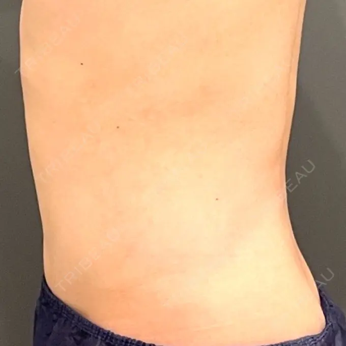 脂肪吸引（お腹） / 脂肪吸引（腰） オアシス美容外科 DAY 97 メイン用