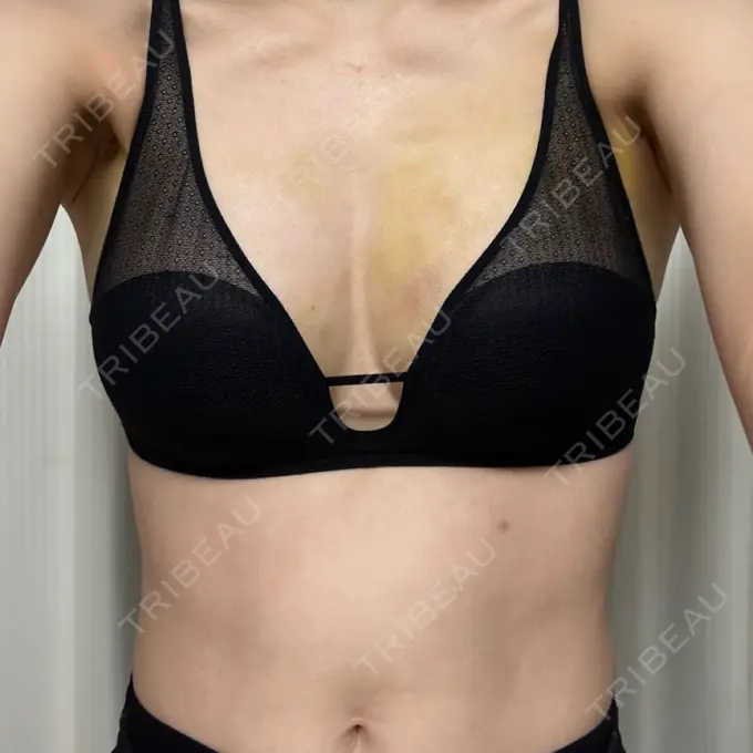 脂肪吸引（脚） / 豊胸（脂肪注入） 湘南美容クリニック Regno 銀座院 DAY 3 メイン用