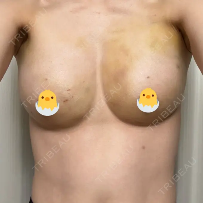 脂肪吸引（脚） / 豊胸（脂肪注入） 湘南美容クリニック Regno 銀座院 DAY 3 メイン用