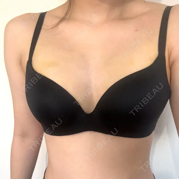 脂肪吸引（脚） / 豊胸（脂肪注入） 湘南美容クリニック Regno 銀座院 DAY 3 メイン用