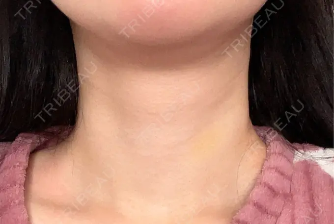 ヒアルロン酸注入（首） 銀座TSUBAKIクリニック AFTER メイン用