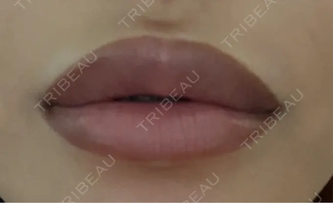 ヒアルロン酸注入（唇） 麻布十番クレールデンタルクリニック DAY 4 メイン用