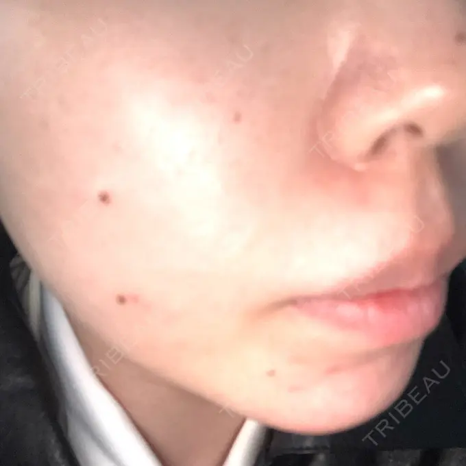 ピーリング（ニキビ・毛穴） Sea Sail Beauty Clinic AFTER メイン用