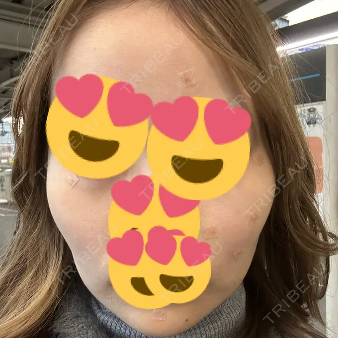 ほくろ・いぼ除去レーザー（肌） 共立美容外科 名古屋院 DAY 0 メイン用