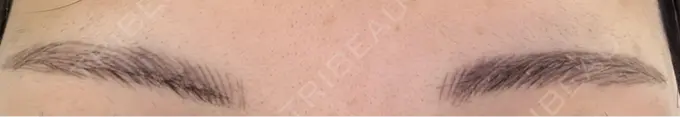 アートメイク（眉） 平和台皮フ科 DAY 5 メイン用