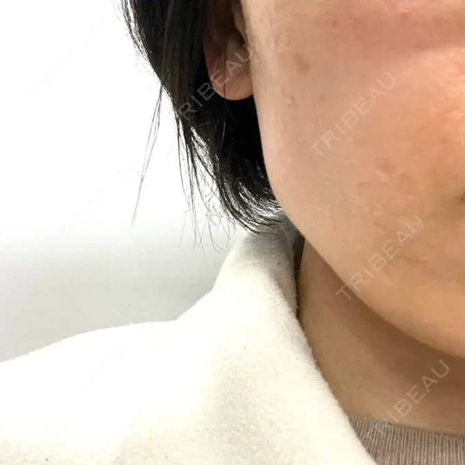 光治療（フォトフェイシャルなど） 銀座TSUBAKIクリニック AFTER メイン用